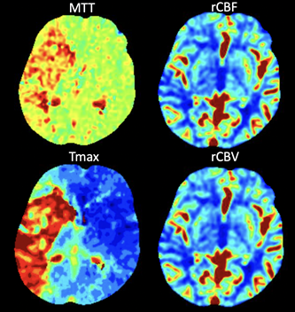 Figure 2. Computed tomographic perfusion (CTP) color map analysis demonstrating large area of right hemispheric ischemic penumbra. (MTT: mean transit time, rCBF: relative cerebral blood flow, rCBV: relative cerebral blood volume, Tmax: time-to-maximum)