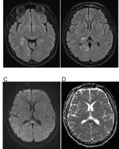 Figure 3. Vasogenic edema and ischemic infarction. (A) and (B) show representative MRI brain axial FLAIR hyperintensities. (C) and (D) are representative axial DWI and corresponding ADC images showing subtle areas restricted diffusion.