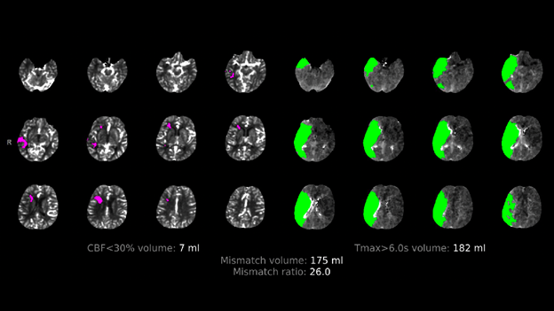 Figure 3. RAPIDTM (iSchemaView, Inc., Menlo Park, CA) automated analysis of CTP data predicting 7 mL core infarct and 175 mL ischemic penumbra within the right hemisphere and a Mismatch ratio of 26.0.