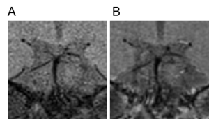 Figure 4. No vessel wall enhancement suggesting against angiitis of CNS. Coronal MRI brain scan before (A) and after (B) gadolinium injection. No significant vessel wall enhancement was seen in the basilar artery or the right posterior cerebral artery.