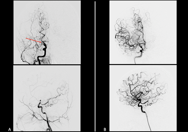 Figure 4. A: Frontal and lateral projection right internal carotid artery (ICA) angiogram demonstrating right ICA terminus occlusion (arrow). B: Post-thrombectomy frontal and lateral projection right ICA angiogram demonstrating thrombolysis in cerebral infarction (TICI) grade 2c reperfusion of the right hemisphere.