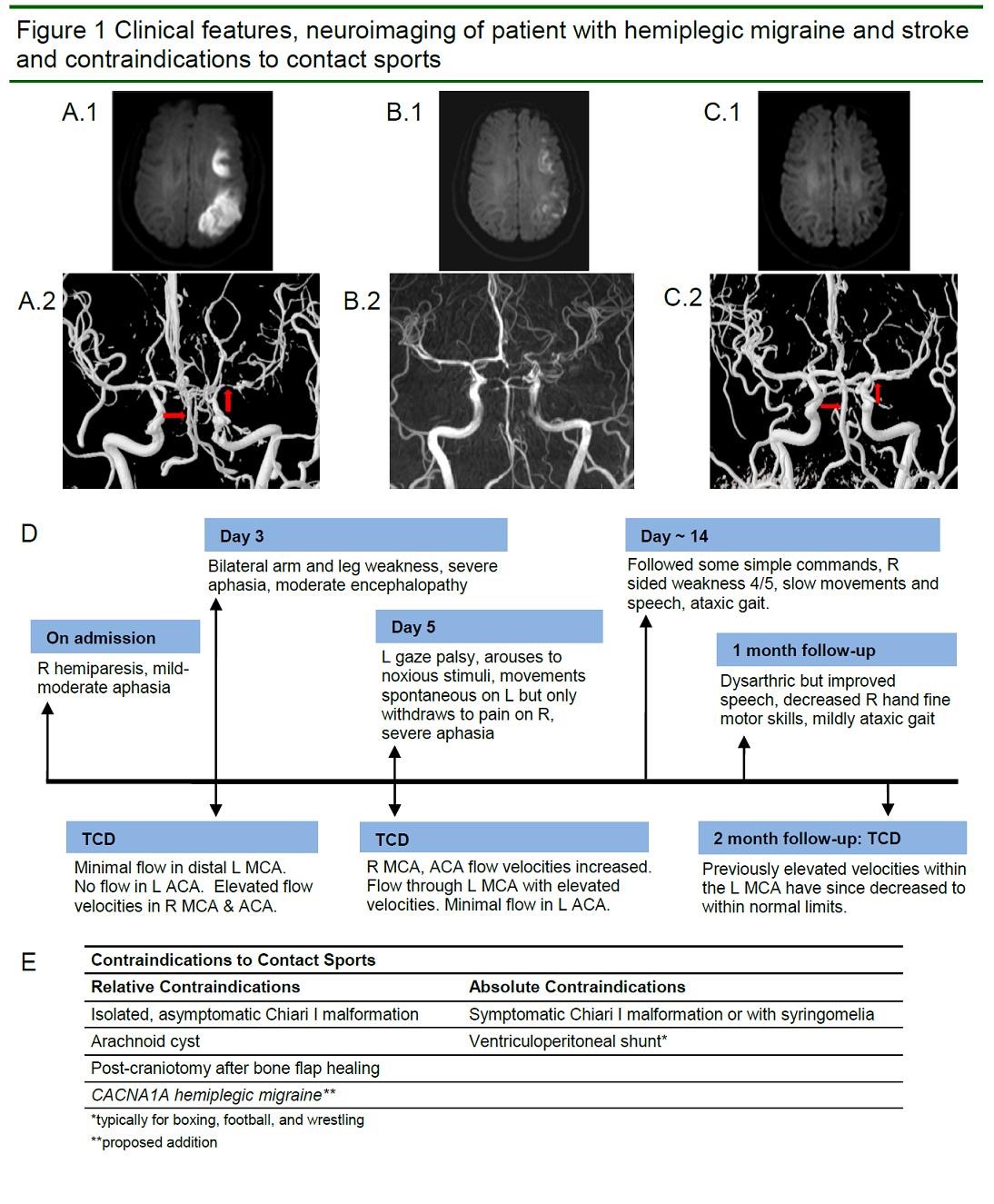 Figure 1 Clinical features and neuroimaging of a patient with hemiplegic migraine and stroke
