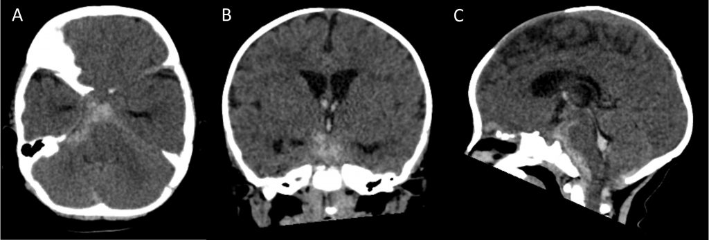 Successful use of intra-arterial verapamil in an infant with vasospasm secondary to aneurysmal subarachnoid hemorrhage - Figure 1