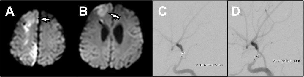 Successful use of intra-arterial verapamil in an infant with vasospasm secondary to aneurysmal subarachnoid hemorrhage - Figure 2